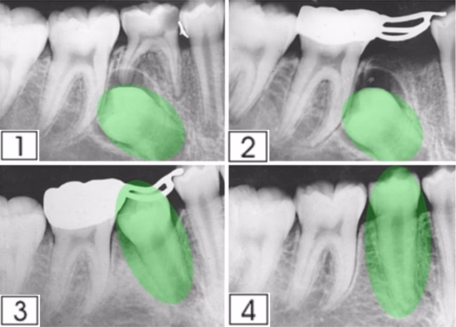 ¿Qué es la expansión ortopédica?