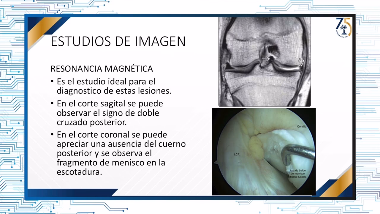 ¿Qué es el asa lateral extraíble?