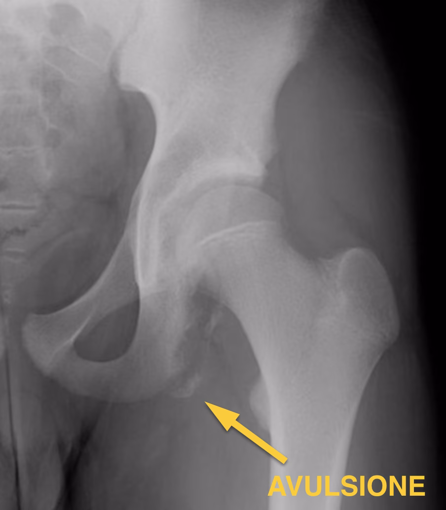 ¿Qué es una fractura por avulsión?
