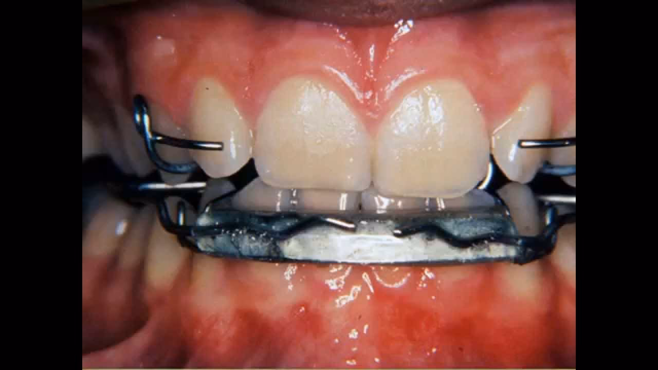 ¿Qué tratamiento dinámico funcional ofrece el aparato de bimler?