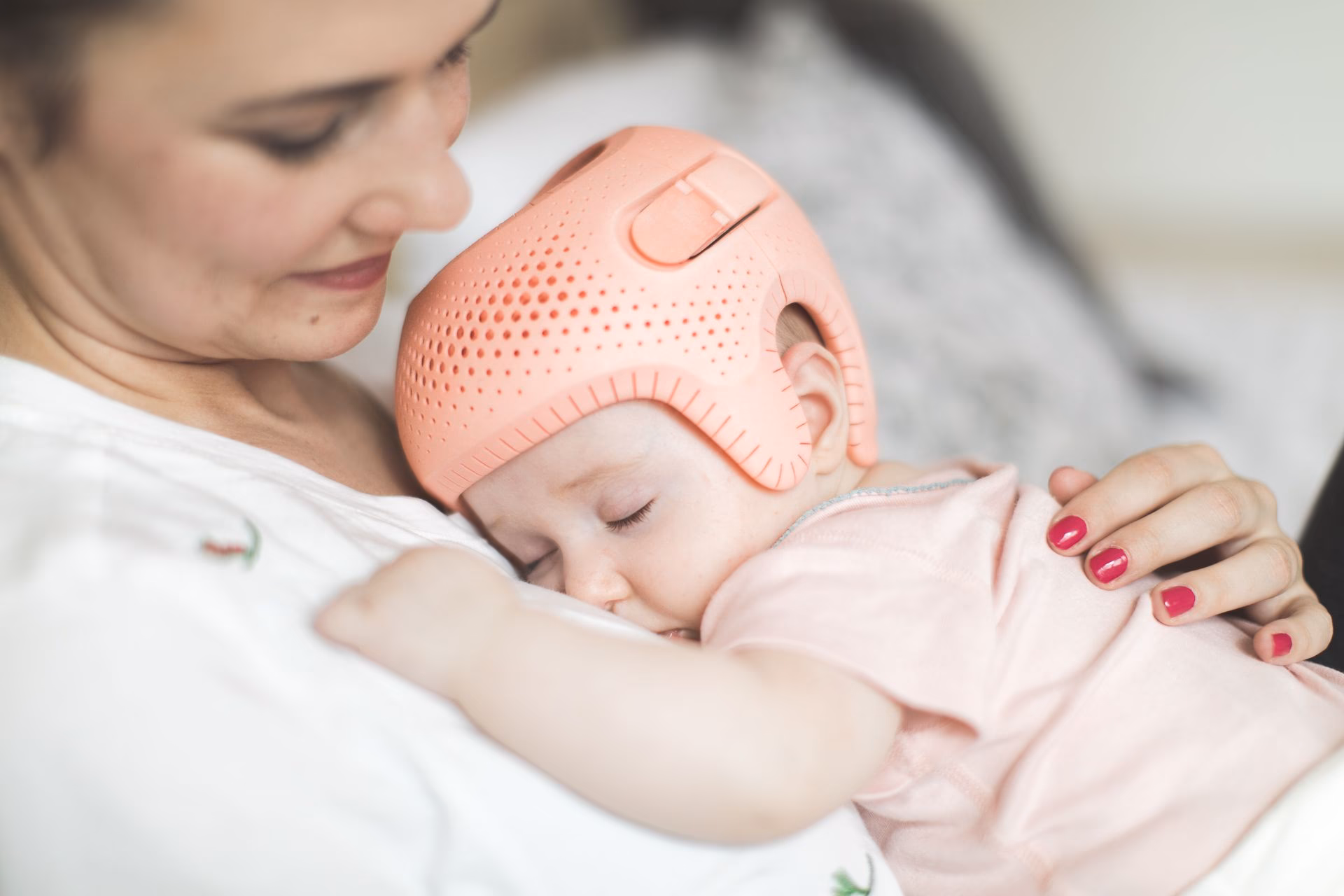 ¿Es aconsejable el uso del casco ortopédico para niños con plagiocefalia grave?