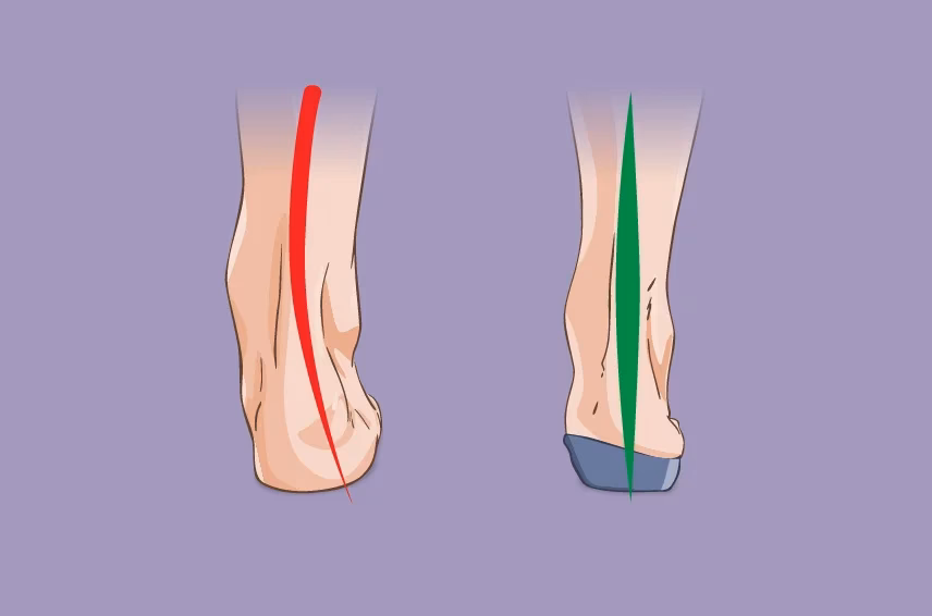 ¿Cuánto tiempo tarda en hacer efecto las plantillas ortopédicas?