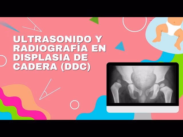 ¿Cómo se trata la DDC?
