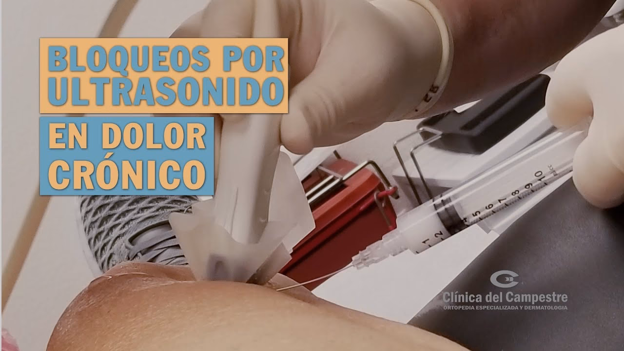 ¿Qué son los bloqueos epidurales?