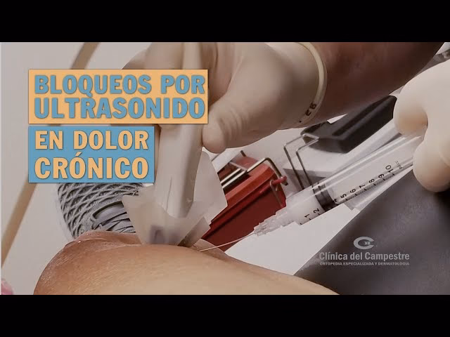 ¿Qué son los bloqueos epidurales?