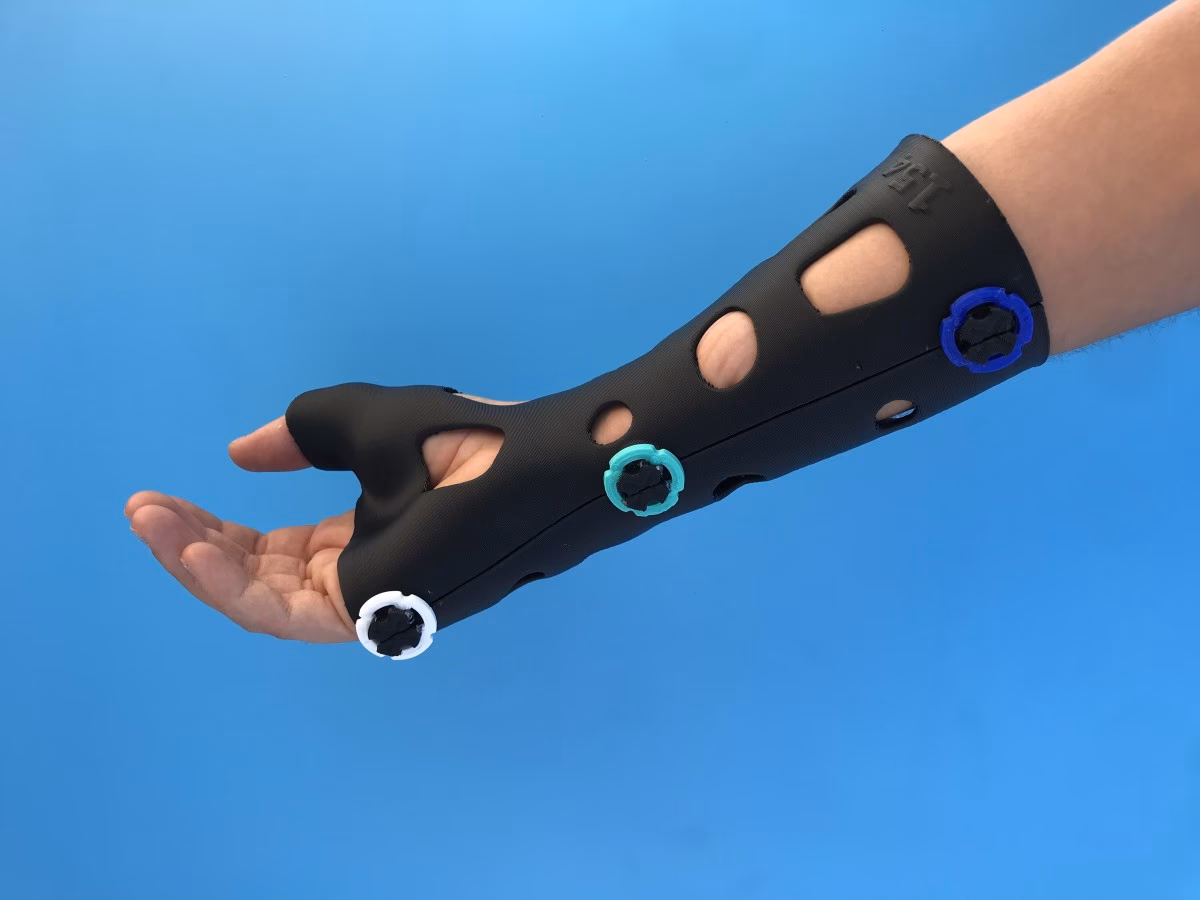 ¿Qué es la fractura del escafoides carpiano?