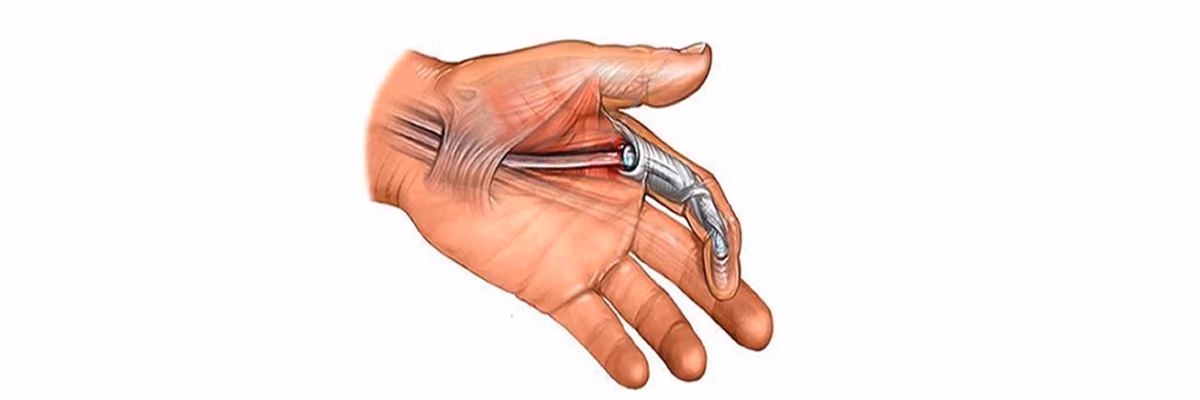 ¿Cómo se diagnostica el punto gatillo?