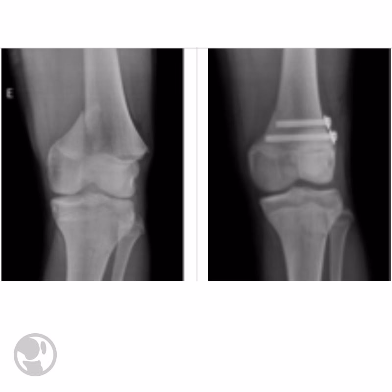 ¿Qué son las lesiones fisiarias?