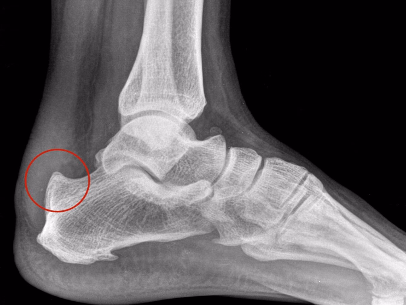 ¿Cómo eliminar la deformidad ósea de Haglund?