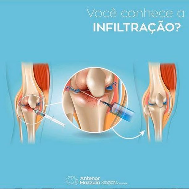 Como é a recuperação de uma infiltração ortopédica?