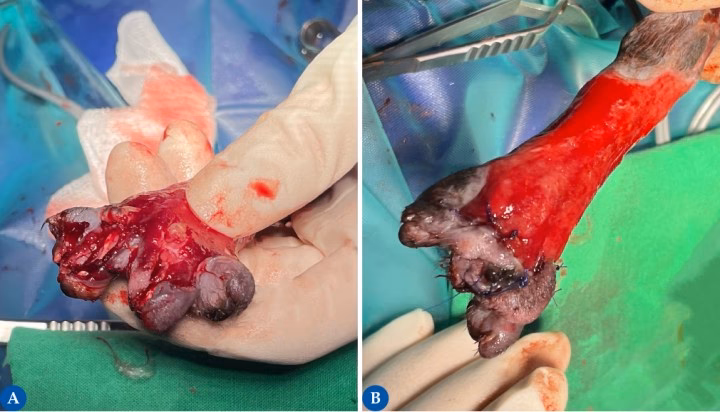 ¿Qué es la cirugía de injerto?