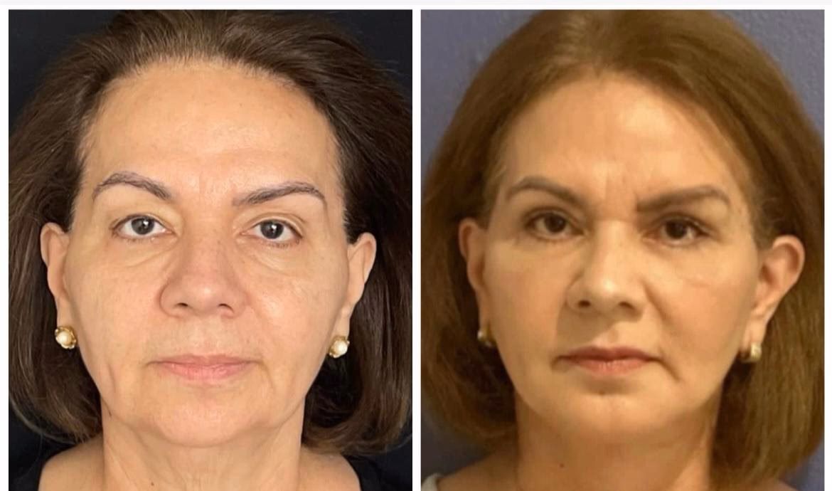 ¿Cuál es el tratamiento más novedoso en rejuvenecimiento y regeneración?