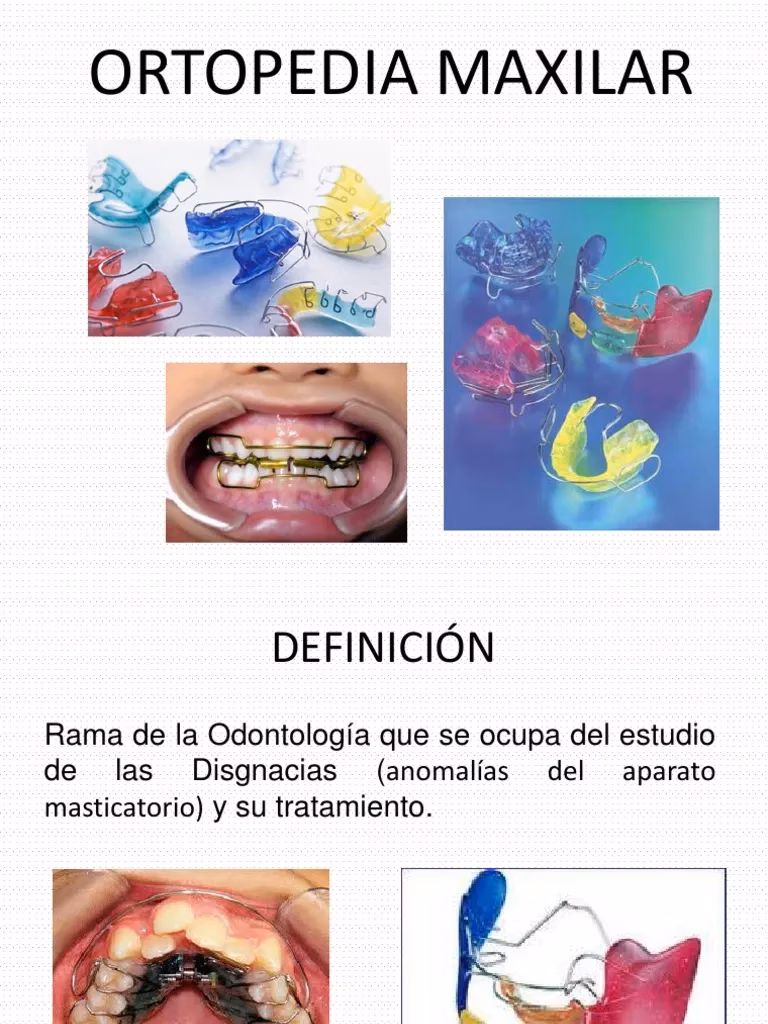 ¿Cuáles son los diferentes tipos de aparatos de ortodoncia?