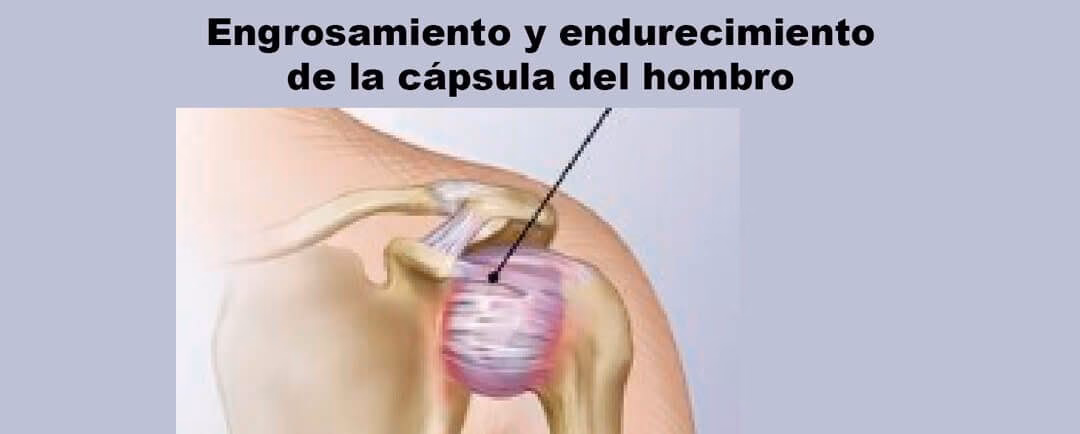 ¿Cómo tratar lesiones en el hombro?