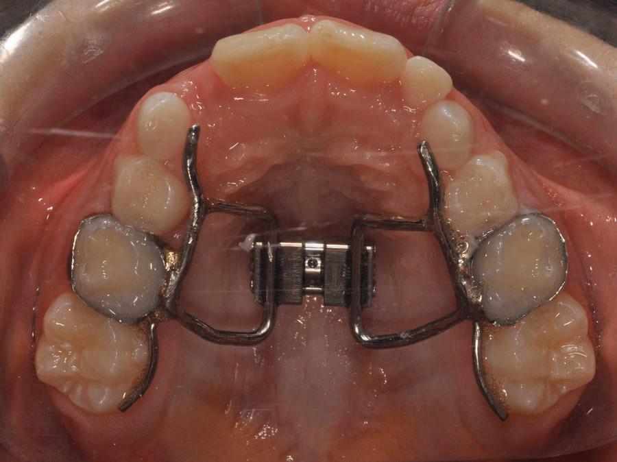 ¿Cuáles son los tipos de aparatos fijos de ortodoncia?