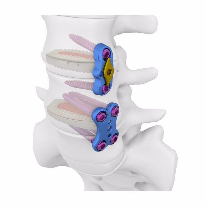 ¿Qué se necesita para mantener la corrección de la fusión articular?