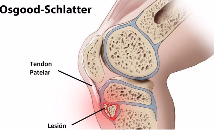 ¿Cómo se cura la enfermedad de Osgood-Schlatter?