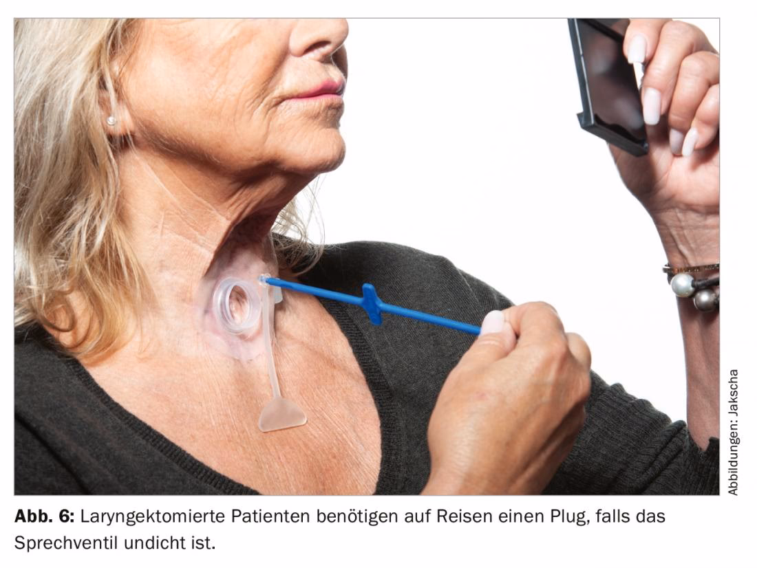 ¿Qué es un laringectomizado?