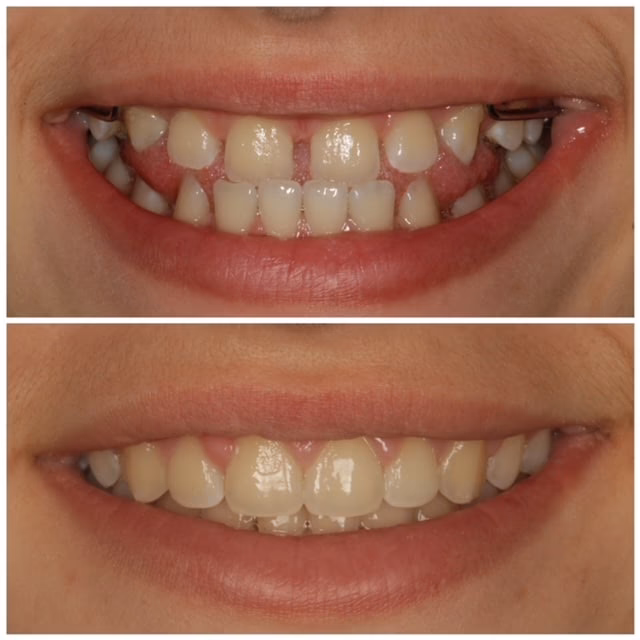 ¿Qué es la Ortopedia Funcional de los maxilares?