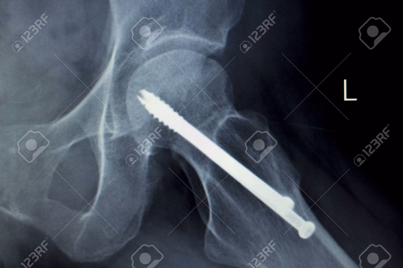 ¿Cuáles son las características de los biomateriales para el área ortopédica?