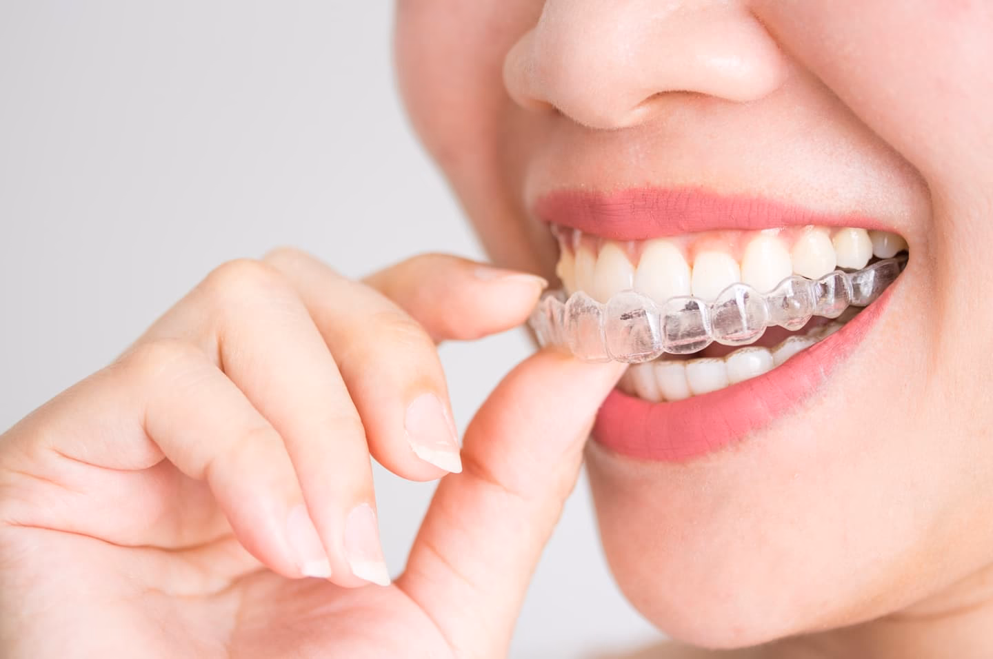 ¿Dónde emergen los incisivos laterales inferiores?